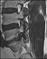 stenoz İnstabilite Dejeneratif spondilolistezis Dejeneratif spinal stenoz Posterior Elemanlar-FASET EKLEM Fset eklem aralığında genişleme; Dejeneratif