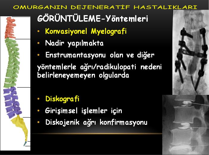 GÖRÜNTÜLEME-Yöntemleri Direkt Grafi/myelografi MR BT/BT Myelografi Diskografi GÖRÜNTÜLEME-Yöntemleri Direkt Grafi Avantajları Hızlı Düşük maliyet Kemik abnormaliteleri Stabilite-dinamik inceleme