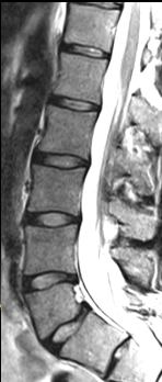 NORMAL DİSK Nukleus P Anulus F End plate (son-plak) Anulusun apofiz bağlantıları NORMAL DİSK T2 ağırlıklı inceleme Anulus fibrozis hipo Nukleus pulpozus-hiper