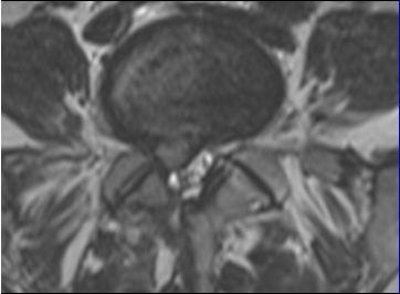 herniasyon Geniş tabanlı herniasyon L3-4 Protrüde herni Ekstrüde herni Migrate herni Sekestre herni Fokal herniasyon Geniş tabanlı herniasyon <90