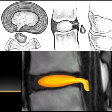 Protrüde disk herniasyonu: Herniye diskin genişliği basal genişliğinden küçük DİSK HERNİASYONU- SINIFLAMA Protrüde disk