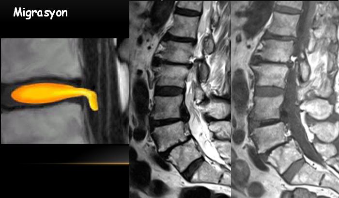 Ekstrüde disk hernisinin tipleri Sekestre disk (sekestre disk parçacığı) Ekstrüde disk hernisinin tipleri Sekestre disk (sekestre disk parçacığı) Ekstrüde disk hernisinin tipleri Migrasyon Ekstrüde