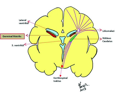 GERMİNAL MATRİKS ANATOMİSİ GM lateral ventriküllerin lateral duvarlarında, duvarın hemen altında subependimal bölgede lökalizedir.