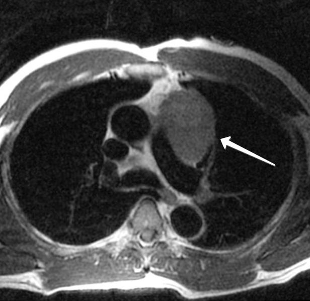 bulgular, başta timoma olmak üzere timusun diğer patolojilerinin araştırılması için anahtar rol oynarlar.