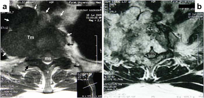 Resim 1: MR (aksiyel): Vertebrada yerleşen, T2 vertebra ve çevre yumuşak dokulara invaze (a) kontrast tutulumu gösteren tümöral kitle (b) görülmektedir.
