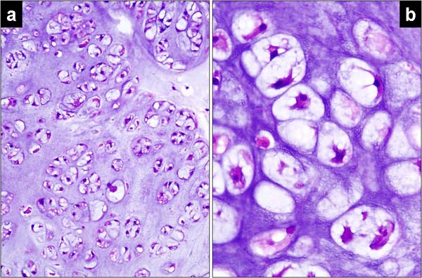 Resim 3: Düzgün fibröz bantlarla ayrılan malign kondroid lobül (a) ve kondroid hücrelerde belirgin atipi görülmektedir (b) (HE, x200).