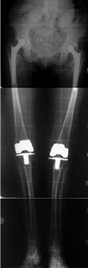Bilsel ve ark. Juvenil romatoid artrit hastalığında total kalça artroplastisinin uzun dönem sonuçları 121 (a) (d) (b) (c) Şekil 1.