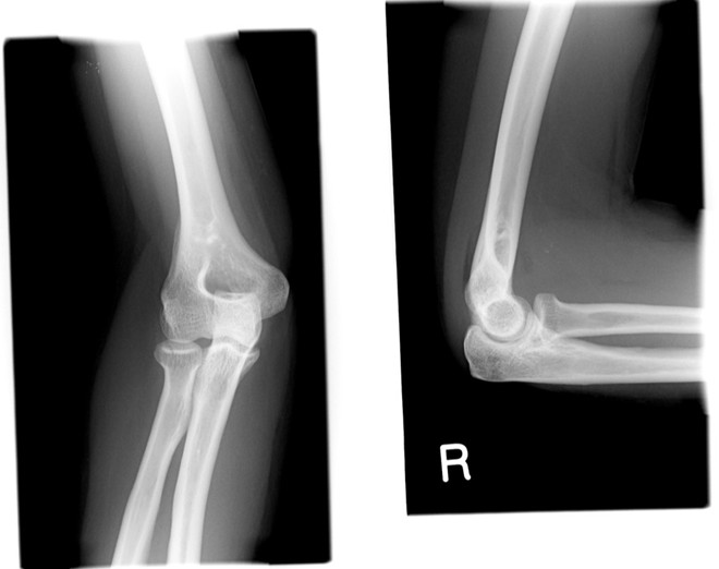 Radial head fracture linear