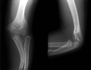 Type III - lateral or anterolateral dislocation of the radial head; - fracture of ulnar