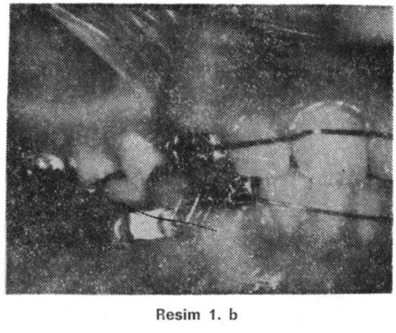 Cilt 12, Sayı 1 ÜNER, YÜKSEL, MERAL Resim 1.a, b, c : Birinci olguda apareyin ağıza uygulanması, lateral hareketlerde apareyin sağ ve soldan görünümleri.