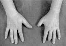 Parmaks zo lu ve ark. El parmak travmatik amputasyonlar nda kallus distraksiyonu yöntemi ile falangeal uzatma 63 lecek flekilde, ortalama 7 kilogram (da l m 5-9 kg) olarak ölçüldü.