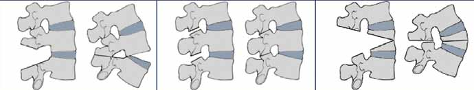 teotomi posterior elemanların çıkarılması, bitişik spinoz çıkıntılara alttan kesme (undercutting) yapılması şeklindedir. Daha sonra osteotomi posteriordan kapatılır.