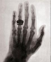 Tarihçe X-ray ilk olarak 1895 te Alman fizikçi Wilhelm Conrad Roentgen tarafından, fotoğraf filminde renk değişmesine neden olan yeni bir ışın çeşidi olarak