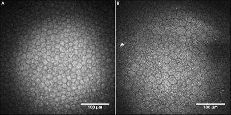 Ophthalmology RESİM 5: (A) 22 yaşında ve (B) 71 yaşındaki iki olguda endotel hücre tabakasını gösteren konfokal mikroskopi kesitleri. p=0,474, endotel hücre dansitesi: p=0,822).
