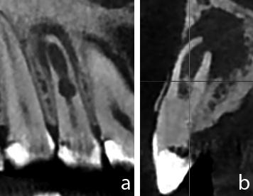 Selcuk Dent J. 2014 Gök, Çapar deneysel immatür diş modelleri ile yapılan bir çalışmada MTA nın dişlerde kırılma direncini de artırdığı belirtilmiştir (Bortoluzzi ve ark 2007).
