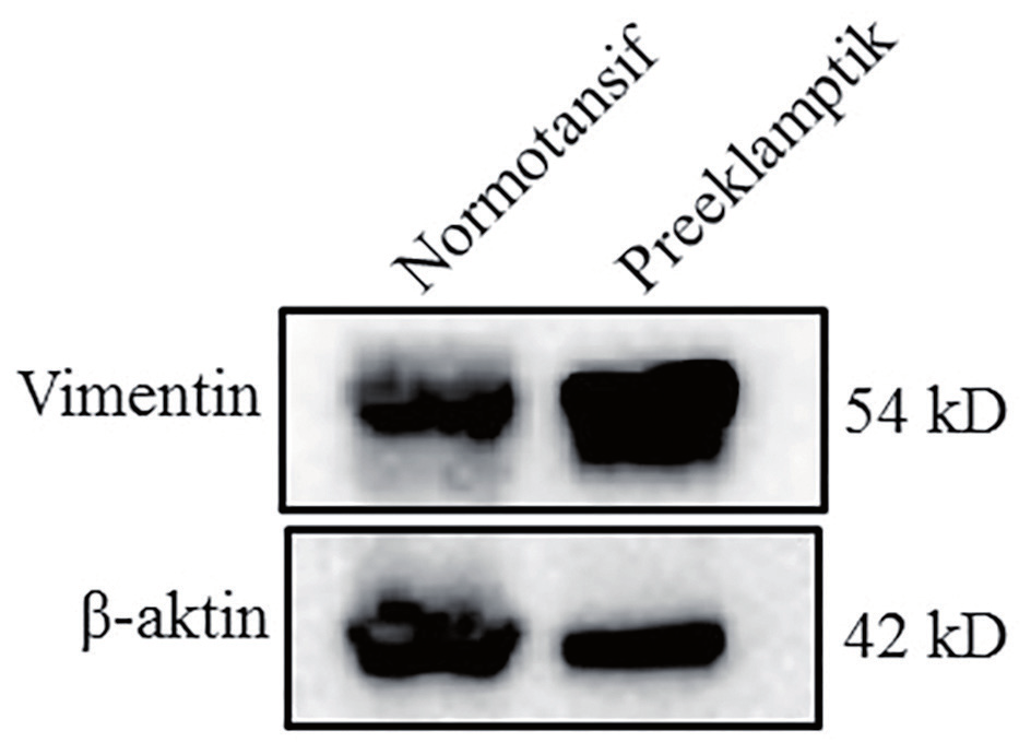 S. İrtegün ve ark. Preeklamptik ve normotansif plasentalarda VEGF ve Vimentin ekspresyonu 403 Resim 1: Preeklamptik ve normotansif plasentaların yapısal ve immunuhistokimyasal incelenmesi.