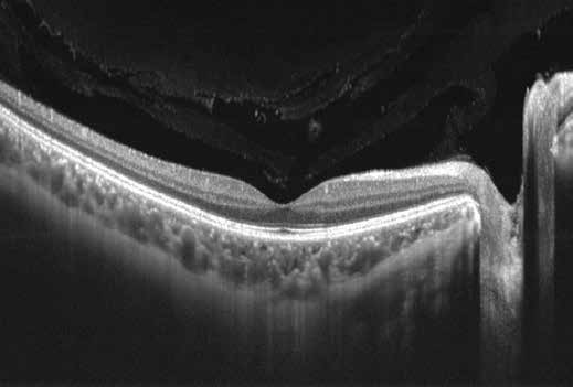 CURRENT RETINA GÜNCEL RETİNA ğü sayesinde tespit edebildiğinden, duyu retinadaki çok küçük yükseltileri dahi gösterebilmektedir.
