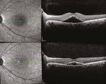 Resim 23: Diyabetik retinopatide OCT görüntüsü (Resim 23).