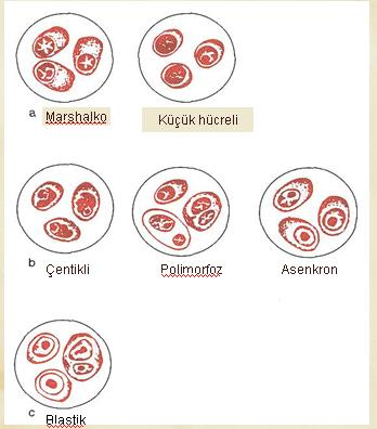 Sitolojik Özellikler Nukleus: matür, küçük hücreli, lenfoplazmasitik, çentikli, polimorfik, asenkron, anaplastik, blastik Dutcher cisimcikleri Sitoplazma: matür, immatür,