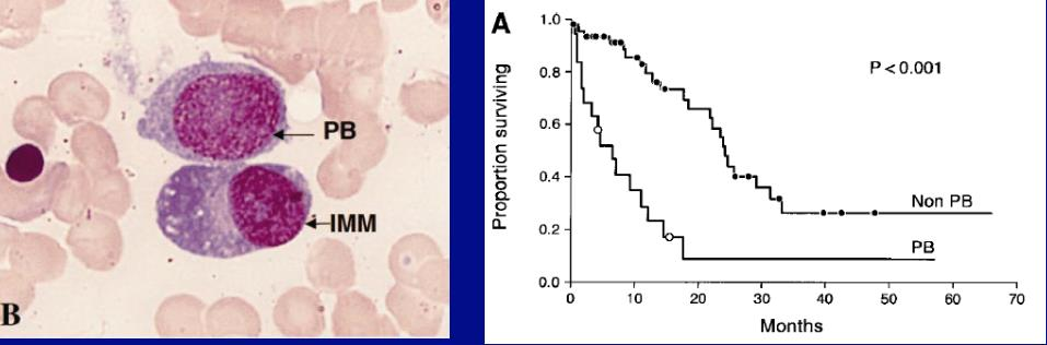 Plazmablastik MM Tanım: >%2 plasmablastik myelom hücreleri Diffüz kromatin patern Nukleus > 10μm veya