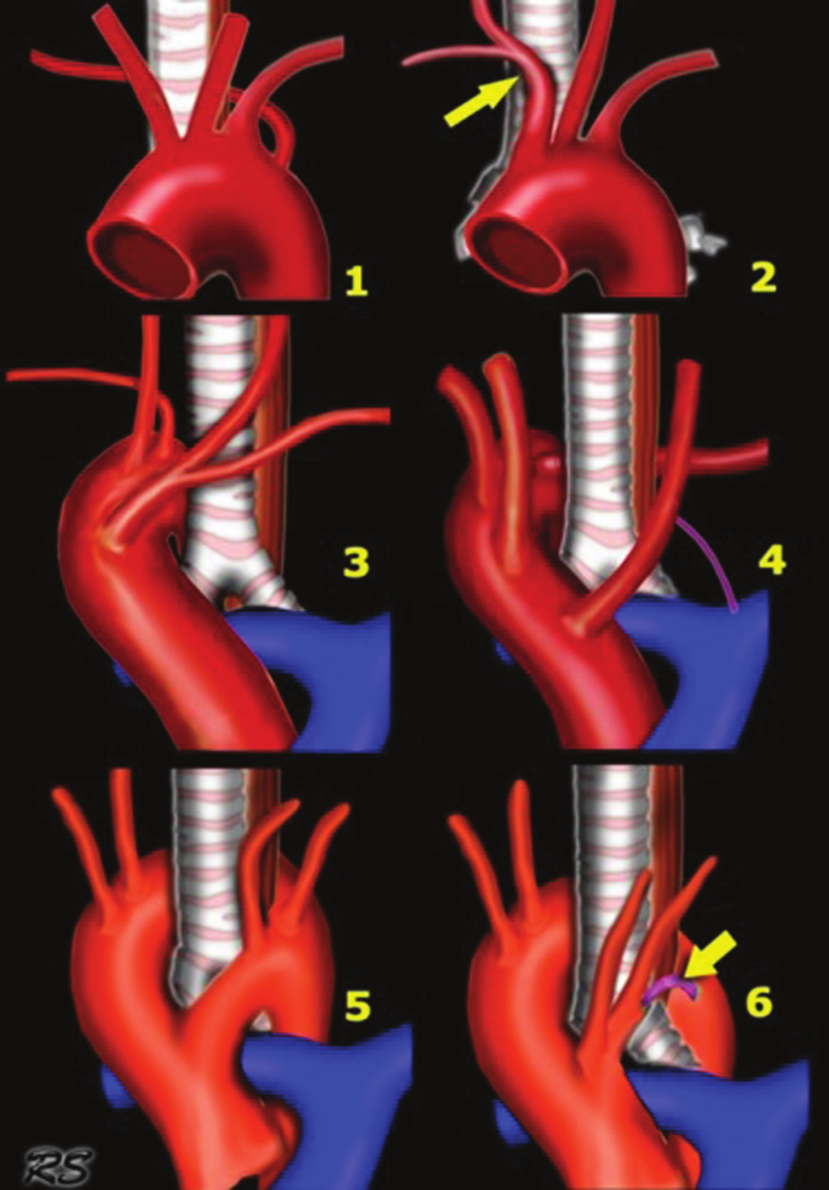 b. Sol arkus aorta ve retroözefajial Kommerel di vertikülü c. Sol arkus Aorta ile sağ inen aorta ve sağ duktus (veya ligamentum) birlikteliği d.