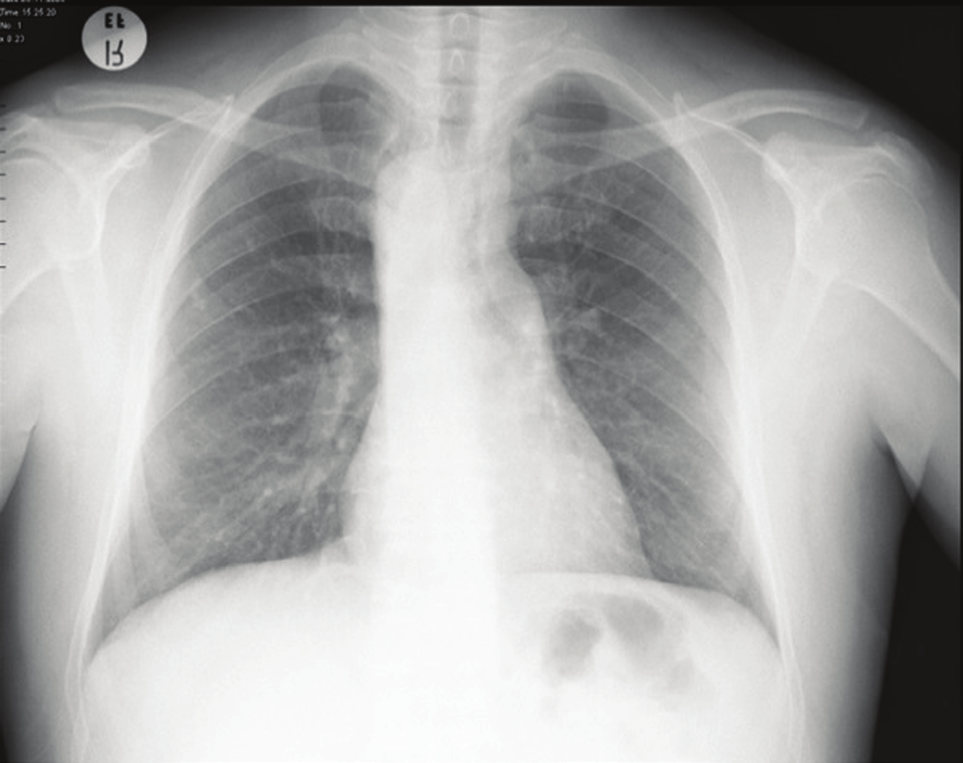 3-boyutlu rekonstrükte BT anjiografik görüntüde arkustan son dal olarak ayrılan sağ subklaviyen arterin sağa ve superiora doğru açılanarak gösterdiği seyir demonstre edilmiştir (beyaz ok).