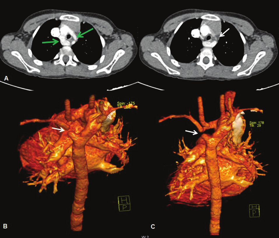 Tip A kesintiler aortikopulmoner septal defekt ve intakt interventriküler septum ile birlikte görülmektedir (Resim 6). PDA, inen aortaya kan akımı sağlamaktadır.