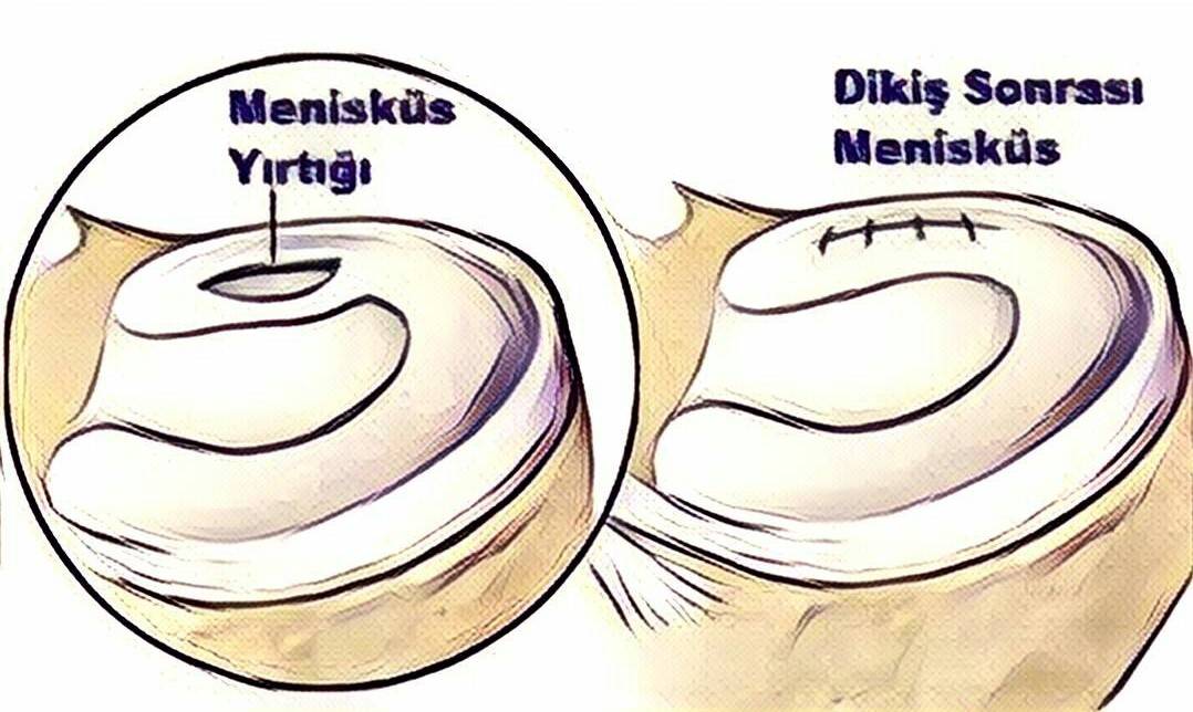 iyileşme şansı varken iç kısımlardaki kanlanma olmayan bölge yırtıklarında hasarlı bölgenin çıkarılması (menisektomi) gerekir. Diz artroskopisi nedir, nasıl uygulanır?