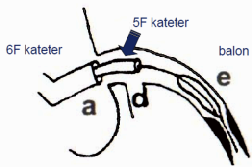 Antegrad yaklaşımda mikrokateter (Tornus, Twinpas (çift lümenli) (Asahi), Progreat (Terumo vb.) ve OTW balon (Ryujin (Terumo), Falcon (Invatec vb.) rutin kullanılmalıdır.