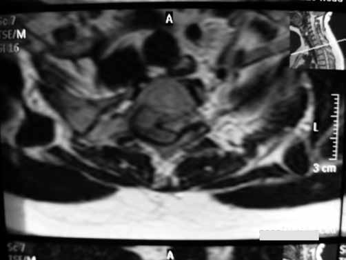 Şekil 1: Olgunun preoperatif T2 kontrastsız sagittal spinal MR larında C7-T1 spinal korda bası yapan kitle görüntüsü.