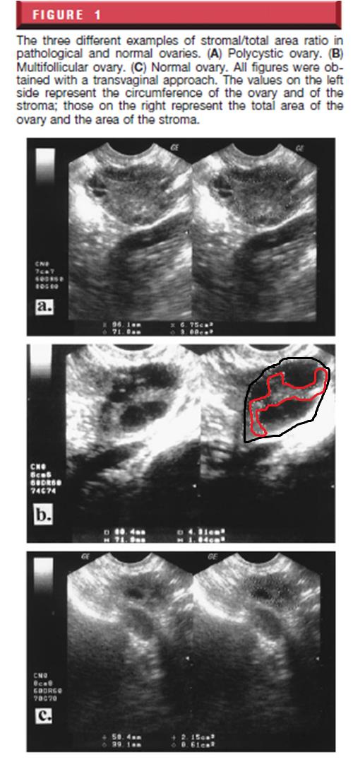 Fulghesu et al. (2001) PKOS fenotipi ve metabolik etkilerini belirlemeye yardımcı olarak bir ovaryan stroma analiz yöntemi öne sürmüştür. Over Stroma/Over Yüzey Alanı (S/A) oranı için eşik değer : 0.