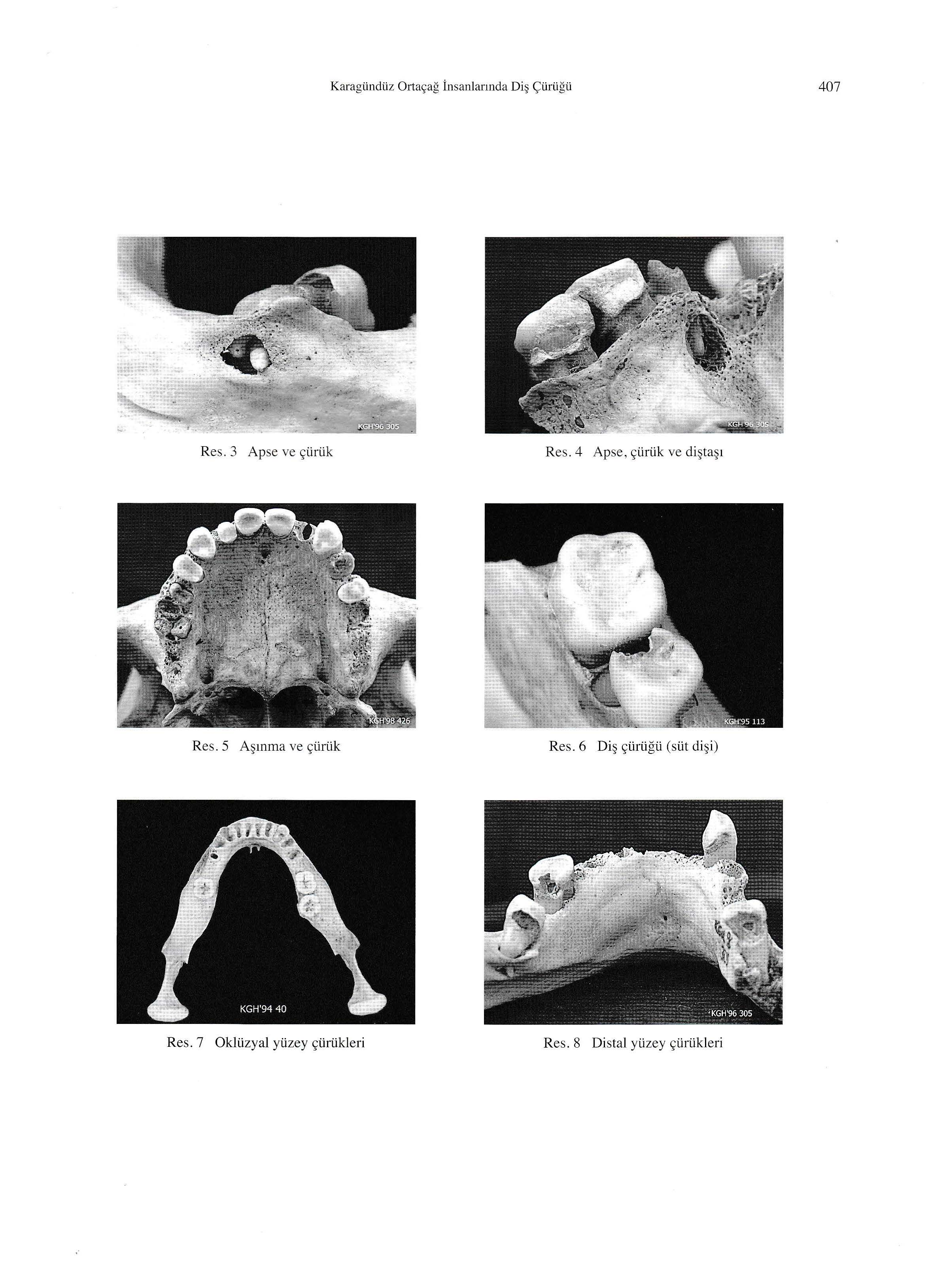 Karagündüz Orta ç a ğ in s anlarında Di ş Çü r ü ğ ü 407 Res. 3 Apse ve çürük Res. 4 Apse, çürük ve di ş taşı Res.