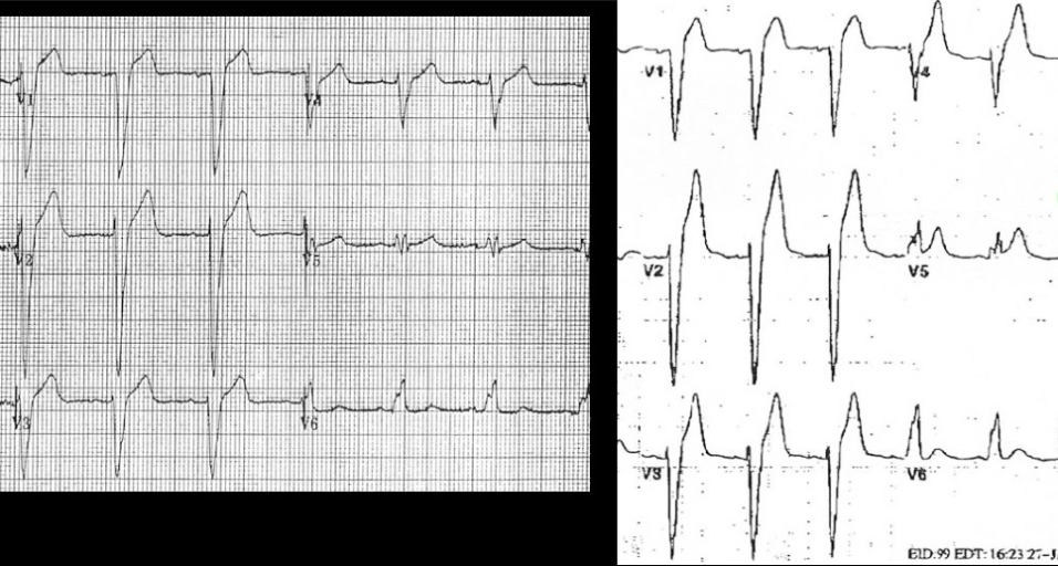 Yaşlı erkek, göğüs ağrısı olup geçmiş ilk çekilen EKG si budur: m EKG de İpuçları ve Atladıklarımız John Fowler, MD, DABEM Kent Hastanesi, İzmir Yaşlı erkek, yeni sol dal bloğu YB dayken göğüs ağrısı