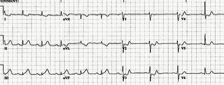 5. olgu 5. olgu Bir saat sonra göğüste garip his hâlâ var Solukluk tekrar terleme Bir EKG daha: 5.