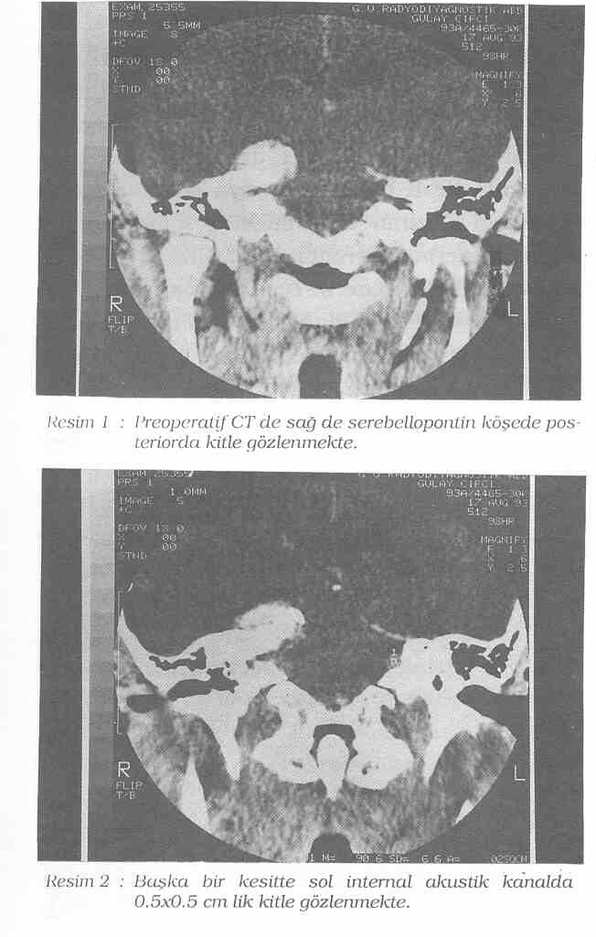 K.B.B. ve Baş Boyun Cerrahisi Dergisi, Cilt: 2 Sayı: l, 1994 yapılar normal değerlendirildi.