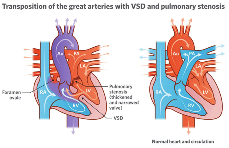 1) BAT ile Ventriküler Septal Defekt Birlikteliği Büyük arterlerin transpozisyonuna en sık eşlik eden anomalidir. Küçük/büyük boyutlu veya nadiren multipl olabilir.