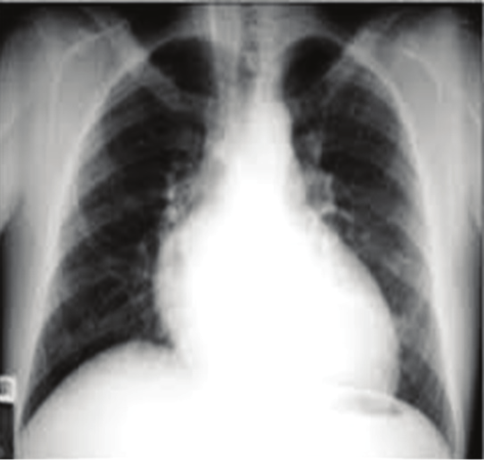 * Subpulmonik membran * Membranöz septum anevrizması * Moulaert kası hipertrofisi (sol ventrikül anterolateral kas demeti) Opere edilmemiş hastalarda erken dönemde hızlı ve progresif bir pulmoner