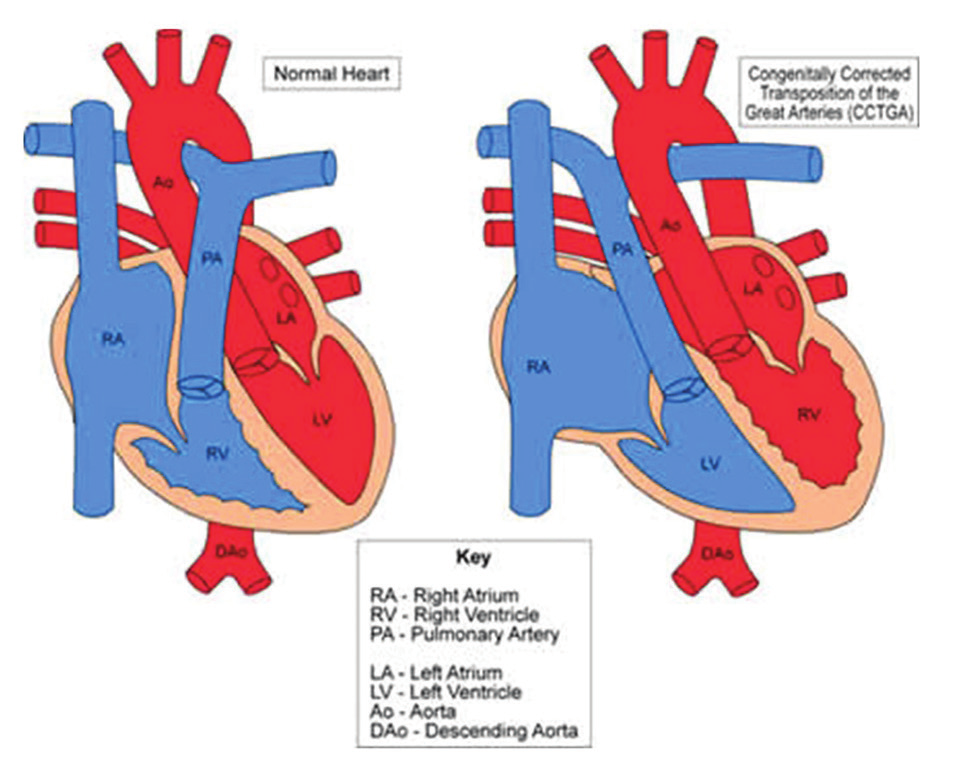 *Düzeltici Metodlar 1. Atrial Switch Prosedürleri (Senning, Mustard) 2. Arteriyel Switch Prosedürü (Jatene) 3. Rastelli Prosedürü 4. Le Compte Operasyonu 5. Damus-Kaye-Stensel Operasyonu 6.