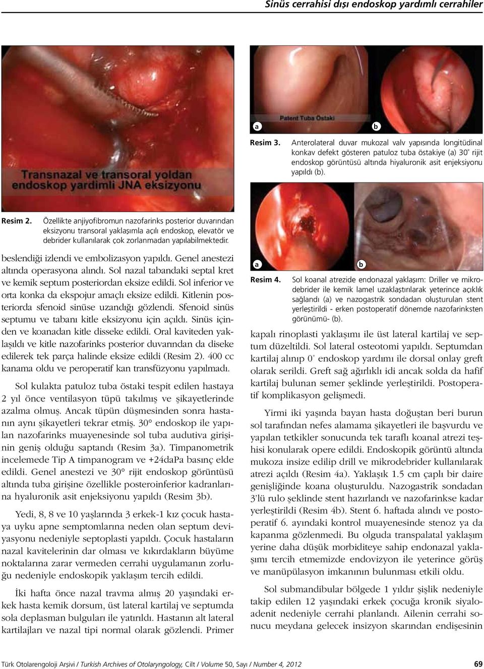 Özellikte anjiyofibromun nazofarinks posterior duvarından eksizyonu transoral yaklaşımla açılı endoskop, elevatör ve debrider kullanılarak çok zorlanmadan yapılabilmektedir.