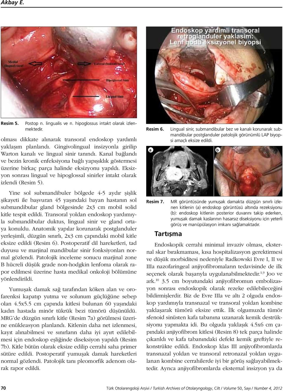 Yine sol submandibuler bölgede 4-5 aydır şişlik şikayeti ile başvuran 45 yaşındaki bayan hastanın sol submandibular gland bölgesinde 2x3 cm mobil solid kitle tespit edildi.