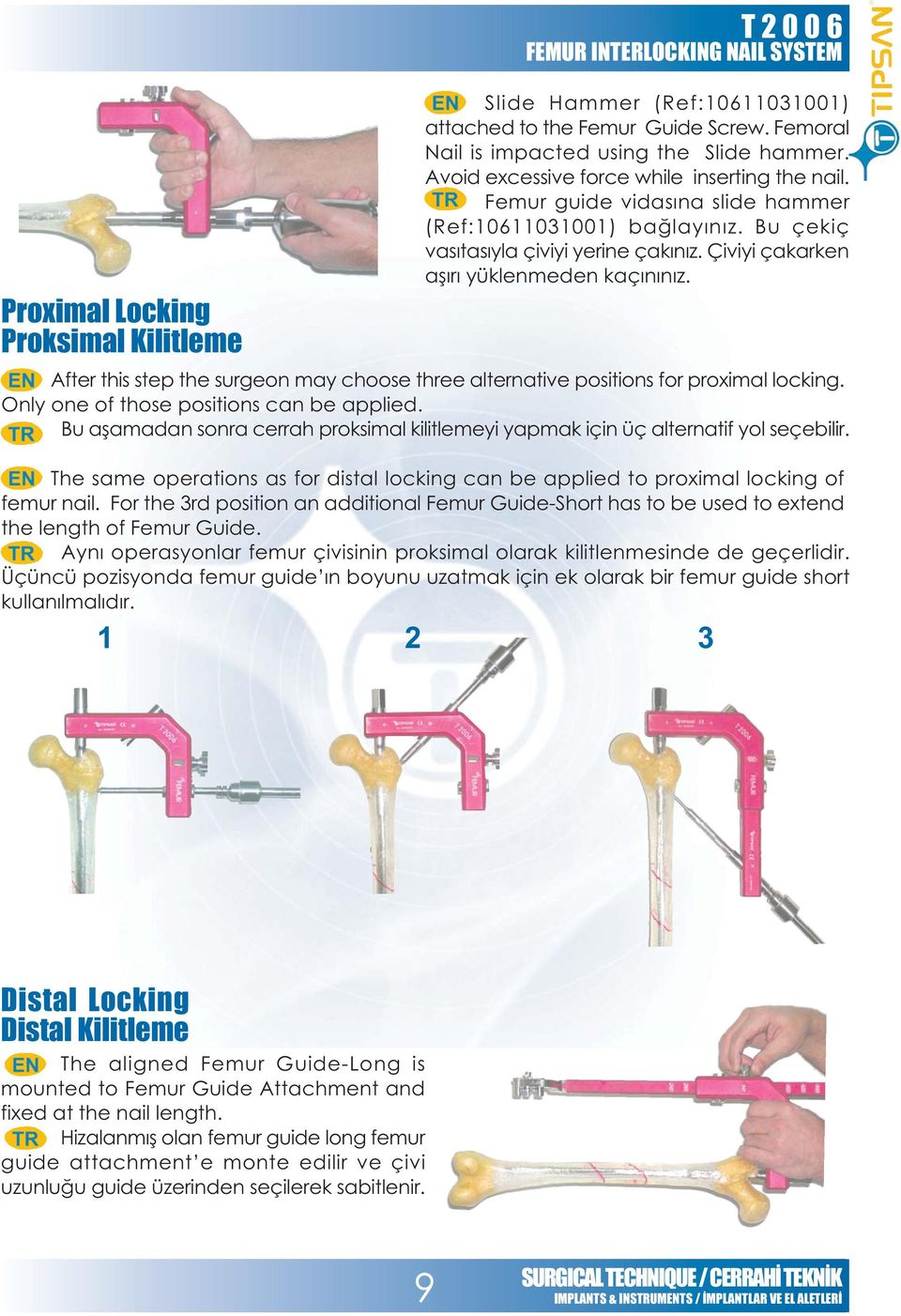 After this step the surgeon may choose three alternative positions for proximal locking. Only one of those positions can be applied.