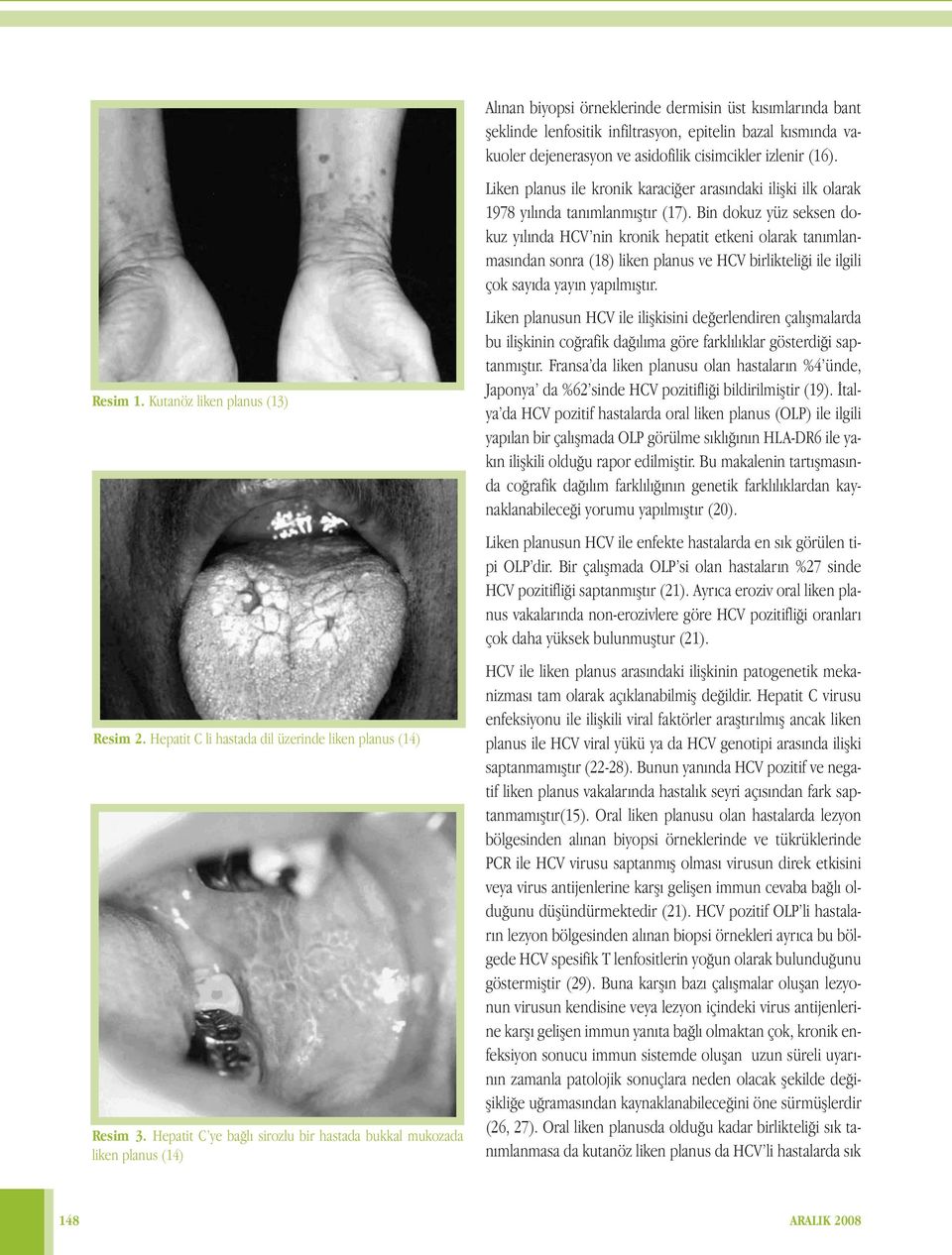 dejenerasyon ve asidofilik cisimcikler izlenir (16). Liken planus ile kronik karaciğer arasındaki ilişki ilk olarak 1978 yılında tanımlanmıştır (17).