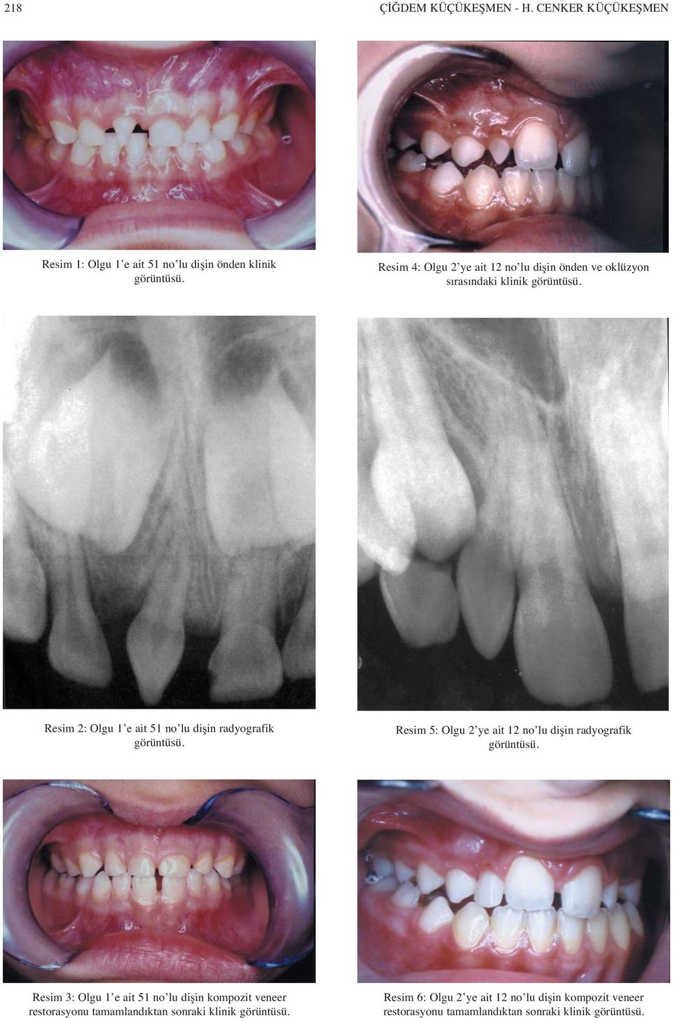oklüzyon s ras ndaki klinik Resim 2: Olgu 1 e ait 51 no lu dişin radyografik Resim 5: Olgu 2 ye ait 12 no lu dişin