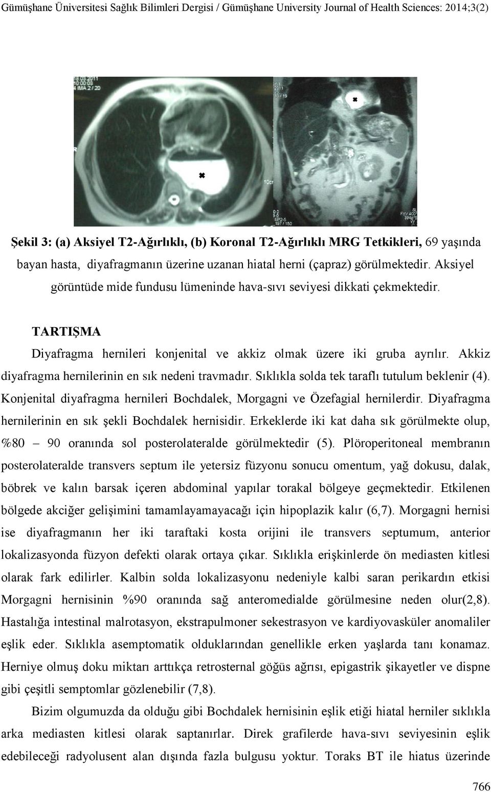 Akkiz diyafragma hernilerinin en sık nedeni travmadır. Sıklıkla solda tek taraflı tutulum beklenir (4). Konjenital diyafragma hernileri Bochdalek, Morgagni ve Özefagial hernilerdir.