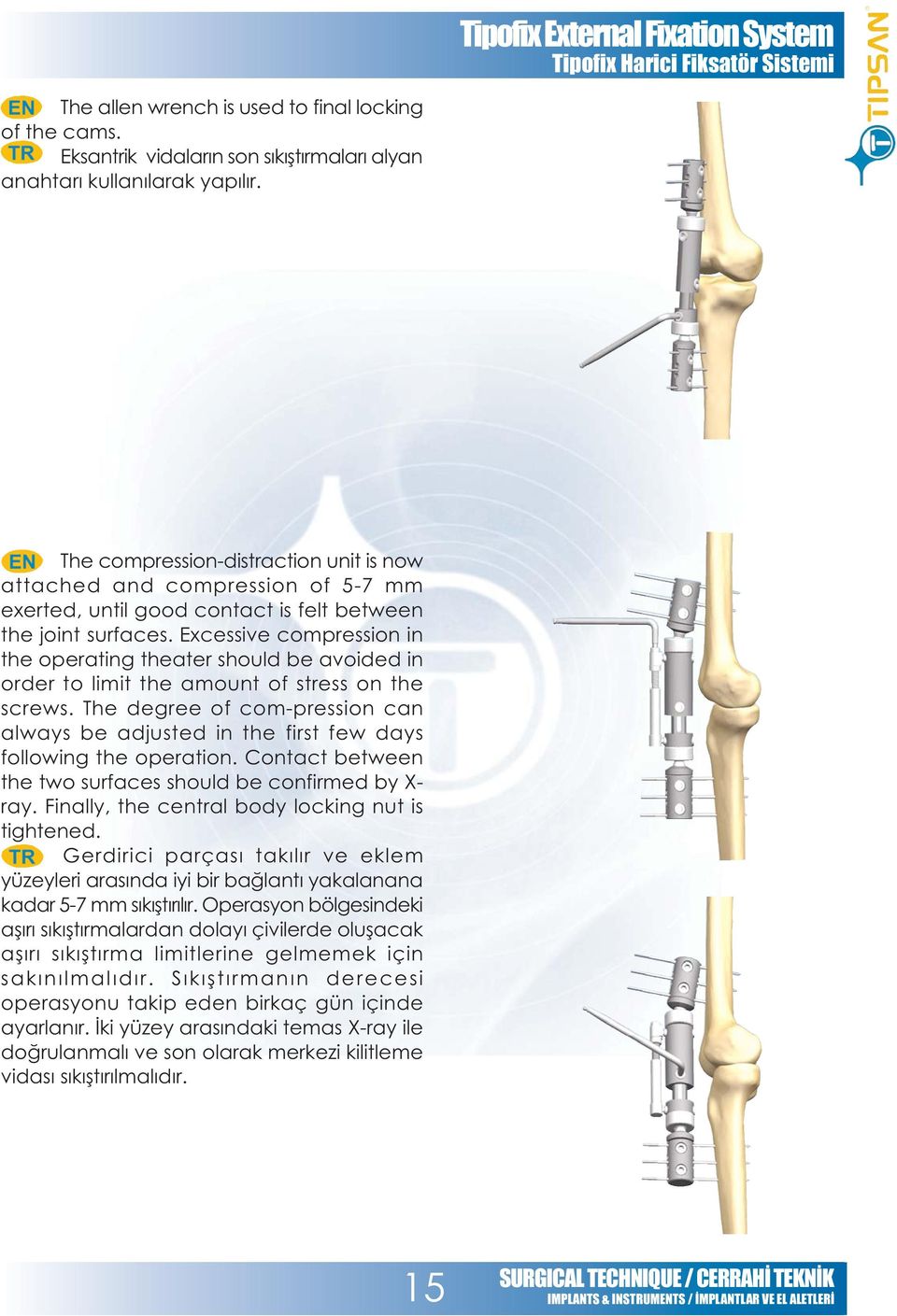 Excessive compression in the operating theater should be avoided in order to limit the amount of stress on the screws.