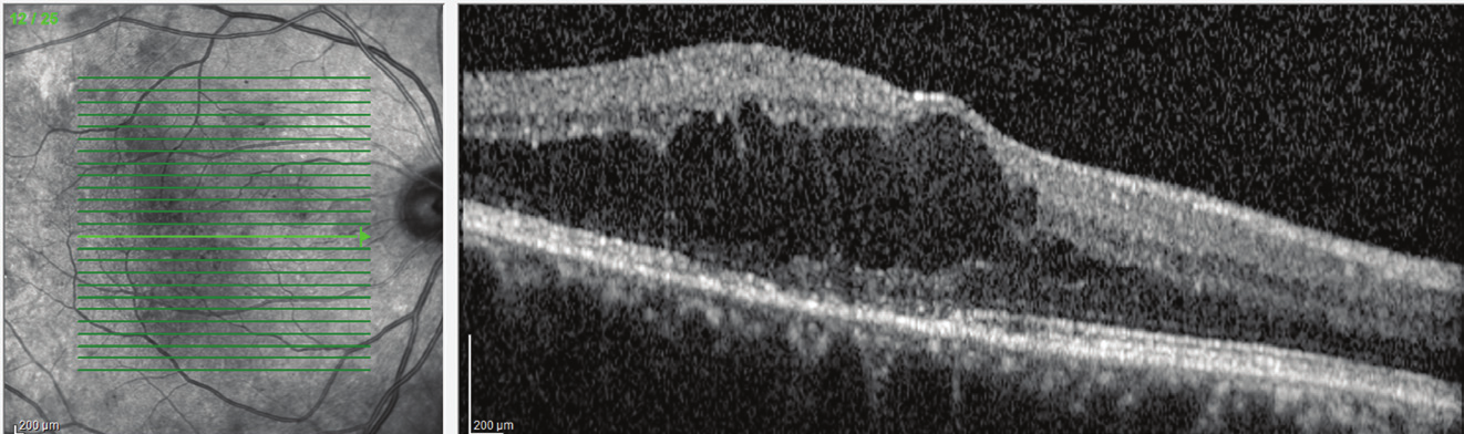 Ret-Vit 2013;21:259-264 Ulaş ve ark. 261 1 2 3 Resim 1-3: Optik koherens tomografi ile alınan retina sinir lifi tabakası ölçüm modu görüntüsü (1).