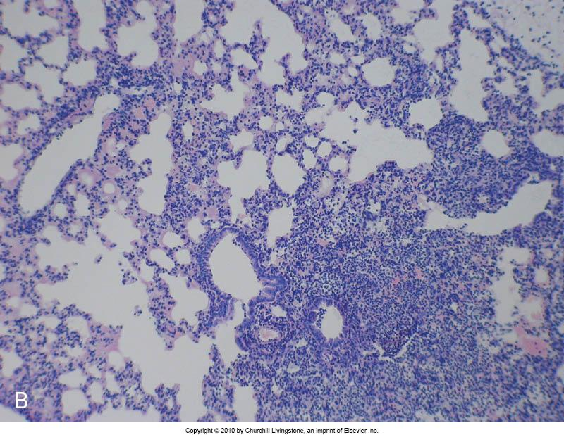 Pathogenesis Patogenez Lokal hasar Trakeal sitotoksin nitrik oksid (NO)