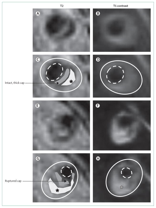 Vertebral arter stenozunda plak kompenentinin High-resolution MRI ile görüntüsü Kontrast sonrası T1-T2 ağırlıklı aksiyel görüntüler (A-D) Açık gri: intakt fibroz kap *Lipid core Kontrast sonrası