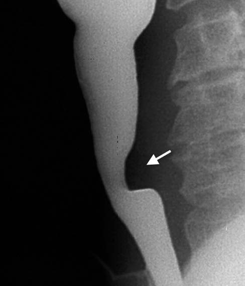 Resim 3. Faringeal web. Anteroposterior görüntüde farinkste çepeçevre ince radyolusen halka şeklinde faringeal web (oklar) ve proksimalinde bir miktar dilatasyon izlenmektedir Resim 5.