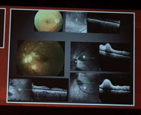 Retinadaki goruntu purtscher like retinopathy Konjestif kalp yetmezligi olan hastanin bulgulariyla ön tanisi enfektif endokardit Karotis Doppler sonucu karotis diseksiyonu.